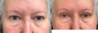 55-64 year old woman treated with Eyelid Surgery - Blepharoplasty Bilateral Upper Eyelid