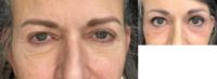 55-64 year old woman treated with Endoscopic Brow Lift (and later CO2 laser of lower lids)