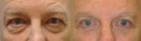 55-64 year old man treated with Eye Bags Treatment