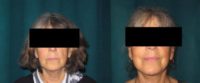 55-64 year old woman treated with Facelift Necklift and Platysmal Plication