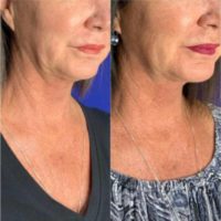 55-64 year old woman treated with Microneedling RF