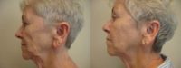 65-74 year old woman treated with Nonsurgical Facelift
