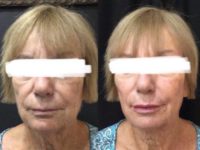 65-74 year old woman treated with Liquid Facelift