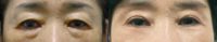 65-74 year old woman treated with Eyelid Surgery, Ptosis Surgery