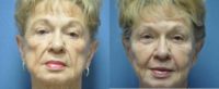 75 and up year old woman treated with Bellafill