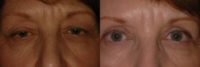 Bilateral Eyelid Lift and Blepharoplasty