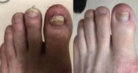 65-74 year old man treated with Laser Toenail Fungus Removal