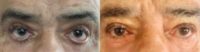 Man treated with Eyelid Surgery, Eyelid Retraction Repair