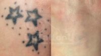 PicoSure Laser Tattoo Removal: Before & After