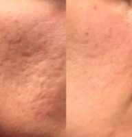 18-24 year old woman with Microneedling