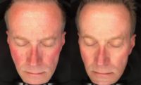 55-64 year old man treated with Skin Rejuvenation