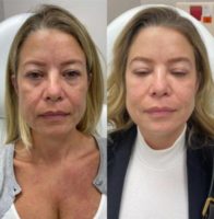 Woman treated with IPL