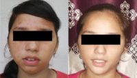 18-24 year old girl treated with Chin Surgery