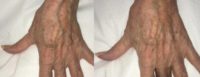 55 year old woman treated with sclerotherapy of hand veins