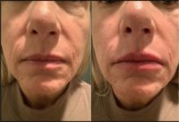55-64 year old woman treated with Dermal Fillers