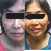 45-54 year old woman treated with Skin Lightening ZO Skin Health products
