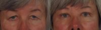55-64 year old woman treated with Blepharoplasty - Eyelid Lift Surgery