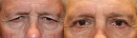 65-74 year old man treated with Eyebrow lift and Eyelid Surgery