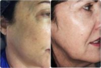 Woman treated with Skin Tightening
