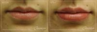 25-34 Year Old Woman Treated With Juvederm Ultra Plus (Lips)