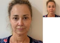55-64 year old woman treated with Nonsurgical Facelift