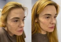 35-44 year old woman treated with Nonsurgical Facelift