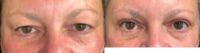 55-64 year old woman treated with Eyelid Surgery - Bilateral Upper Lid Blepharoplasty
