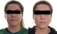 28 years old woman treated with Buccal Fat Removal