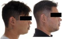 30 years old man treated with Genioplasty