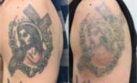 PicoSure Tattoo Removal
