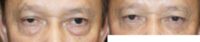 55-64 year old man treated with Ptosis Surgery