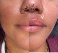 35-44 year old woman treated with Dermal Fillers, Lip Fillers