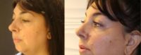 Filler to lateral cheeks