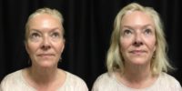 Woman treated with 1ml Restylane to Tear Trough