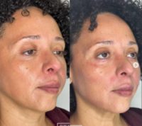Woman treated with Nonsurgical Facelift