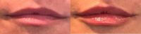 45-54 year old woman’s lips treated with Injectable Fillers