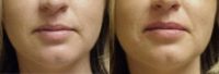 25-34 year old woman treated with Juvederm Volbella
