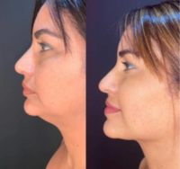 35-44 year old woman treated with Facial, SMAS Facelift, Deep Plane Facelift, Eyelid Surgery, Facelift, Facelift Revision