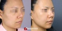 25-34 year old woman treated with Chin Surgery