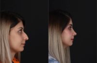 18-24 year old gender nonconforming person treated with Rhinoplasty