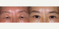 Treated with Eyelid Surgery