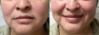 30 year old woman treated with Lip Fillers