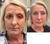 65-74 year old woman treated with Laser Resurfacing, Dermal Fillers, Botox