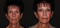 55-64 year old woman treated with Non Surgical Face Lift