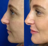 45-54 year old woman treated with Lip Filler