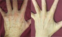 55-64 year old woman treated with BroadBand Light (BBL)