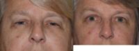 External ptosis repair, droopy eyelid repair, 62 yo female