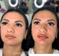 Woman treated with Lip Fillers, Cheek Fillers