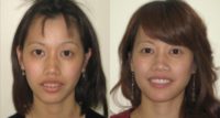 Woman treated with Orthognathic Surgery