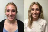 Woman treated with Botox for Gummy Smile